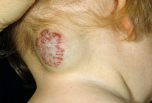 dermnet_photo_of_cavernous_hemangioma