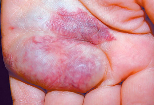 mh_photo_of_venous_malformation_on_hand