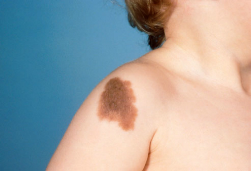 phototake_photo_of_congenital_nevus