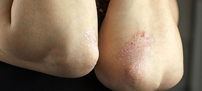 psoriasis_660_346934498