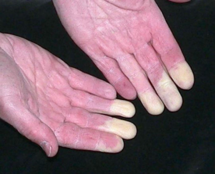 Φαινόμενο Raynaud