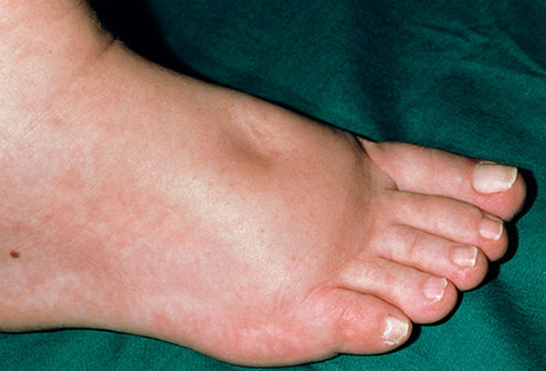 edema