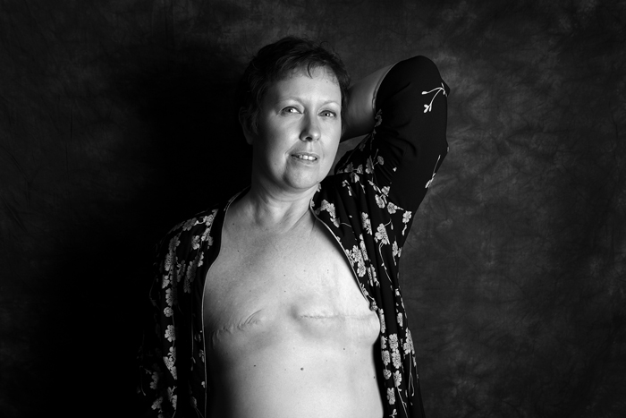 Mastectomy By Ami Barwell